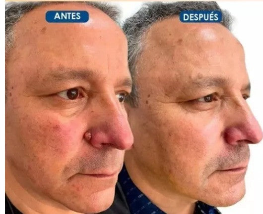 PARCHE ANTI VERRUGAS - CUIDADO DE LA PIEL EL KIT CONTIENE: 3 sobres X 108 parches redondos